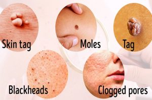 Remove Moles Warts Blackheads Skin Tags And Age Spots With These Natural Remedies 300x197 