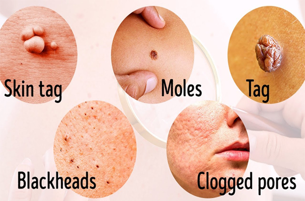 genital skin tags on skin multiplying