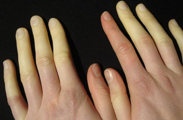 what to avoid with raynauds